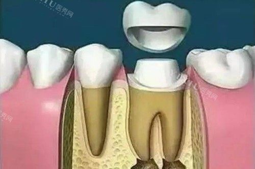 根管治疗戴牙冠卡通图