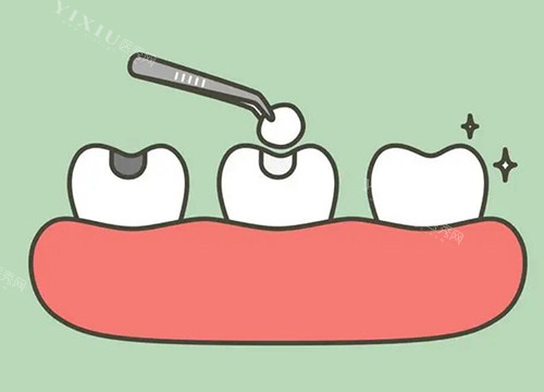 年轻人补牙避坑！松风树脂虽好但有这些弊端，快来了解其他选择！(图1)