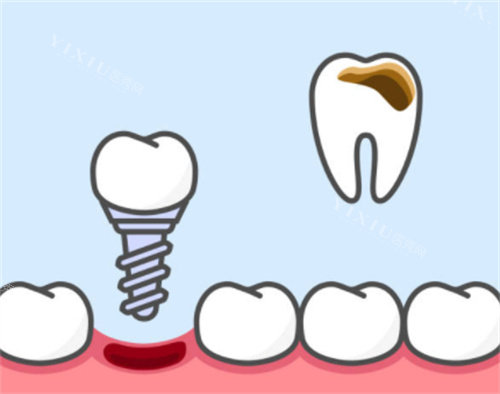 惊呆了！郴州美嘉美口腔 2025价格表曝光，种植牙低至 1380 元起！(图2)