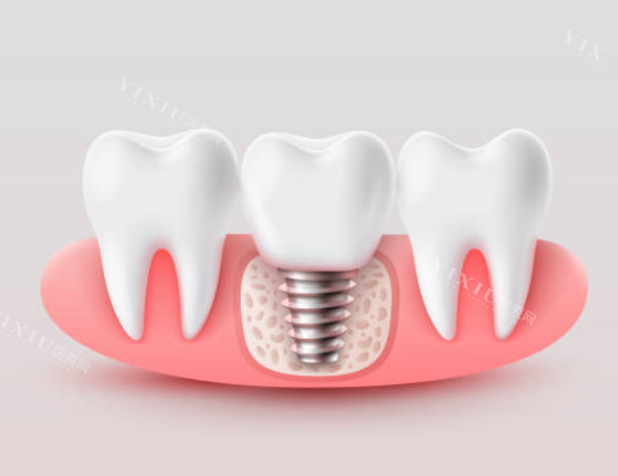 低于3000元起的种植牙能种吗？牙医警告：可能是翻新植体，5年脱落率达20%(图5)