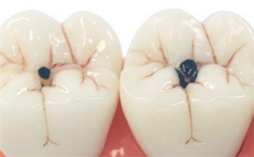 宝宝乳牙蛀了要补吗？很多家长做错了！(图3)