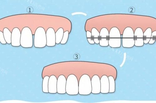 2025年深圳百大口腔正畸费用：金属6500元起，正雅12800元起，自锁8800元起，隐适美26800元起！(图11)