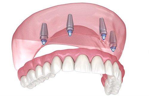 韩国奥齿泰TS3 CA亲水型种植体怎么样？采用了亲水性表面处理技术，在材料选择和价格定位上都有其独特之处(图1)