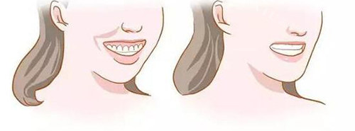 正畸中的辅助装置都包括哪些？正畸中的辅助装置都包括活动矫治器、支抗装置、牵引附件等(图4)