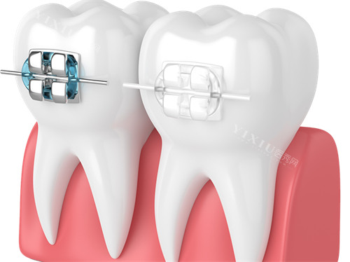 矫正牙齿必看：为什么正规正畸不会导致持久性牙齿松动？显要解释来了(图1)