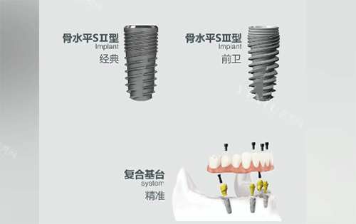 安联种植牙用起来怎么样