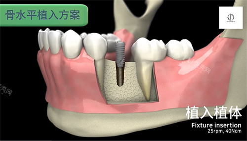 韩一种植体怎么样