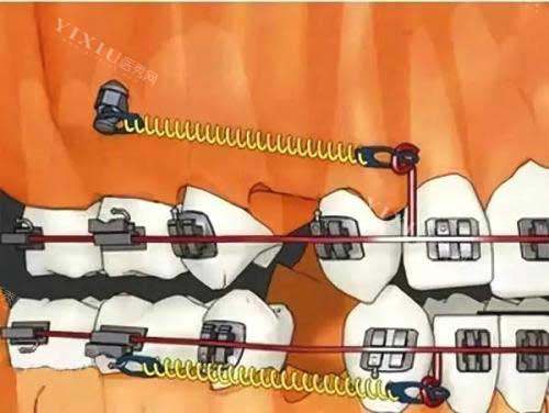 正畸中的骨钉是打在哪个位置呢？上下颌后牙区是骨钉植入的常见位置之一(图3)