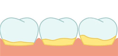 【2025】广州暨穗正合口腔价格表揭秘：韩系种植2990元起、陶瓷矫正12800元起、拔智齿299元起，价格透明！(图5)