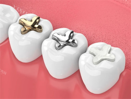 大冶哪里补牙拔牙比较好？从基础补牙到复杂拔牙，中山／渡江／铜都等10家优势及价格全公开！(图4)