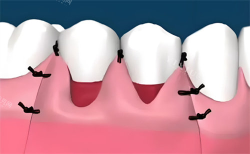牙龈萎缩治疗