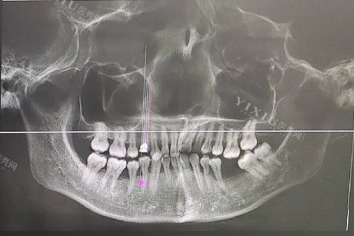 牙周炎 牙龈萎缩 缺牙