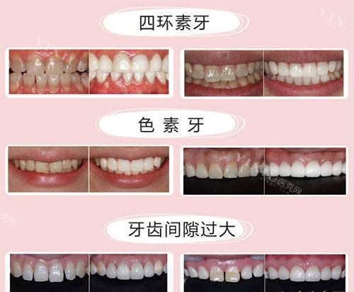不同牙齿需要美白的示意图