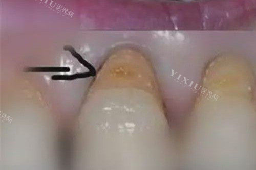 牙齿楔状缺损照片