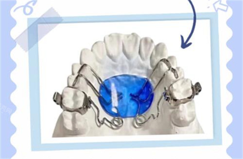 钟摆式矫治器外形