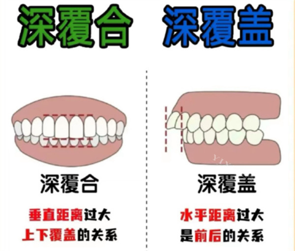 深覆合跟深覆盖的区别对比
