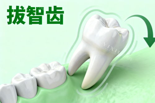 阻生智齿卡通展示图