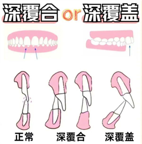 深覆合跟深覆盖的区别