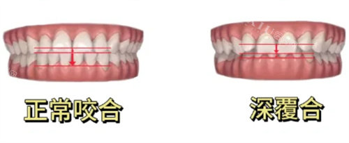 正常咬合和深覆合对比