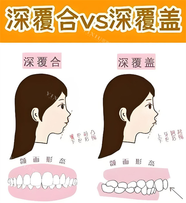 深覆合跟深覆盖对比