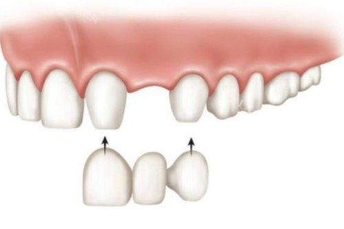 镶牙安装卡通图