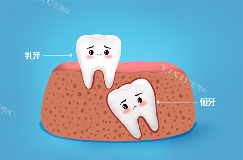 乳牙滞留