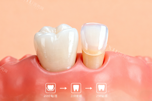 西安周至县种植牙哪家强？当地牙友亲测推荐，技术扎实收费透明，种牙选择不再迷茫！(图5)