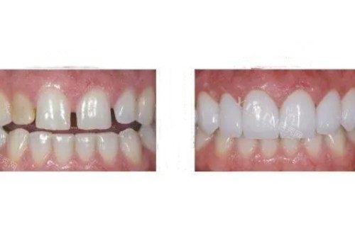 牙齿贴面修复卡通图