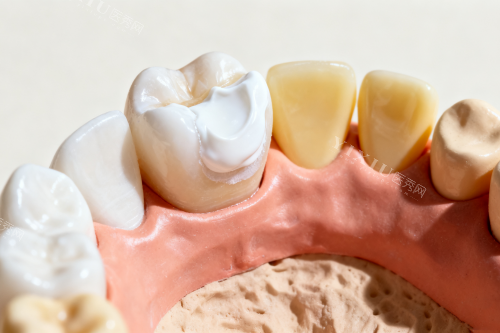 牙齿镶牙卡通展示图