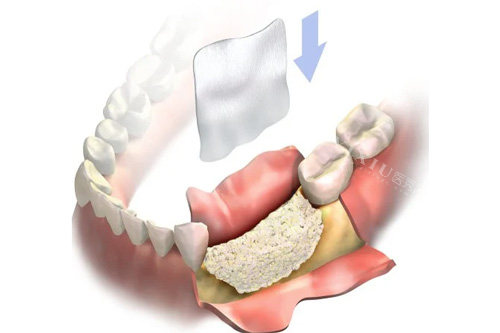 牙齿植骨示意图