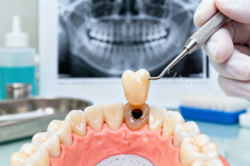 蛀牙修复卡通图片一览