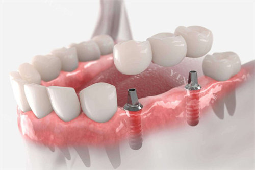缺牙三颗种植连桥冠
