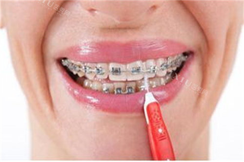 正在做正畸的牙齿宣传图