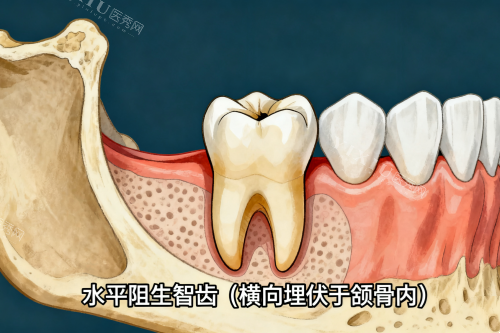 水平阻生智齿一览