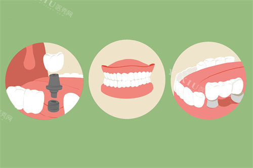 缺牙修复方式
