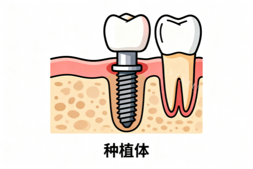 缺牙修复卡通展示图