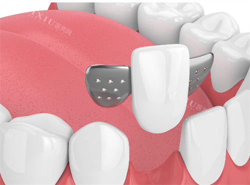 马里兰桥适合人群