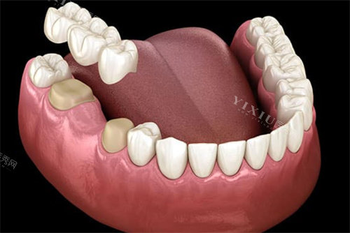 大牙5号牙缺牙桥冠修复