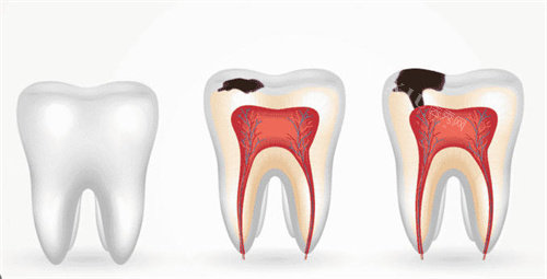 牙釉质龋坏造成蛀牙