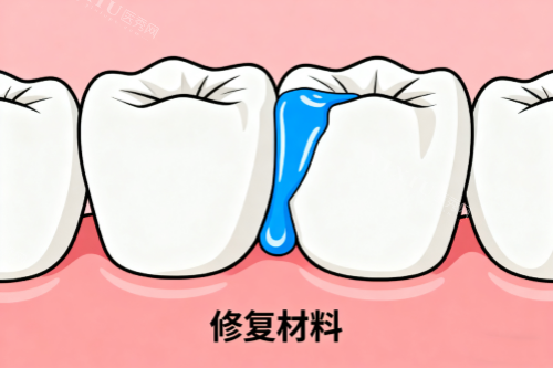 牙齿修复材料展示图