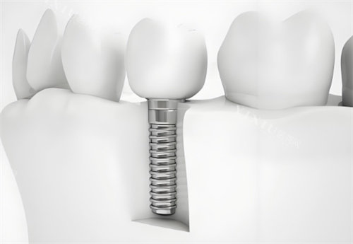 种植牙模型图片