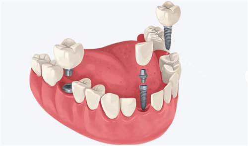 种植牙动画展示