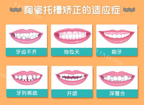 陶瓷半隐形矫正适应症