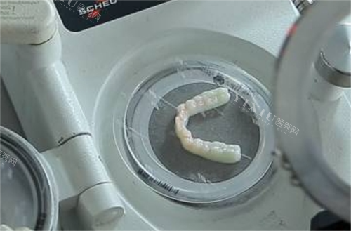 隐形矫正制模过程