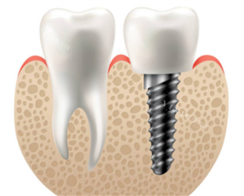 种植牙和正常牙对比图