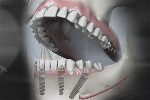 德国SKY种植牙模拟图