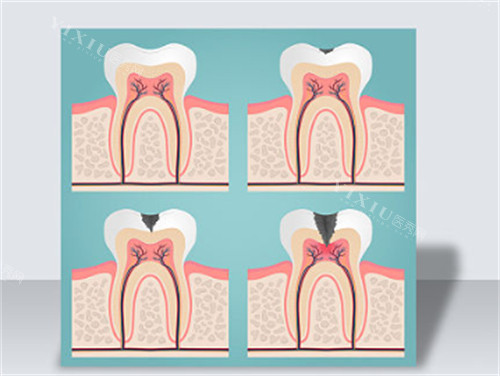 不保护牙齿的危害