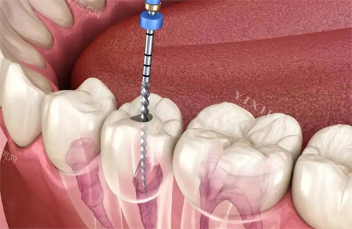 根管治疗动画透视图