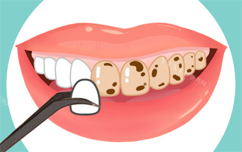 牙齿贴面动画图