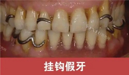 挂钩假牙展示示意图